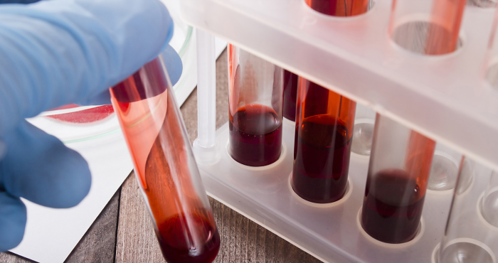 BRCA testing on the rise for those without breast or ovarian cancers